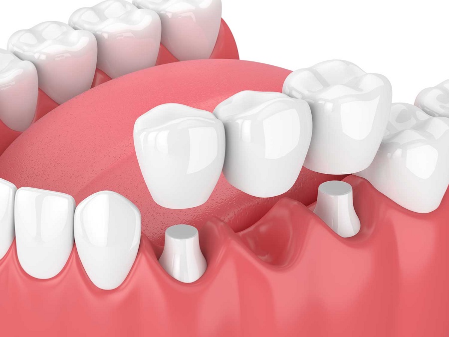 کلینیک دندانپزشکی مهر گاندی -راهنمای متقاضیان پروتزهای ثابت متکی بر دندان.jpg